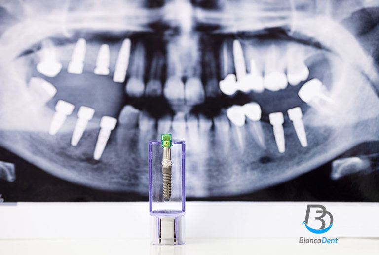 Implante dental con Rayos X