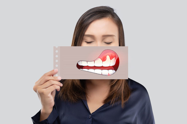 Gingivitis Dental: BiancaDent, Clínica Dental Castellón