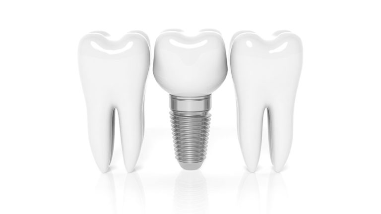 Implante dental: BiancaDent, Clínica Dental en Castellón