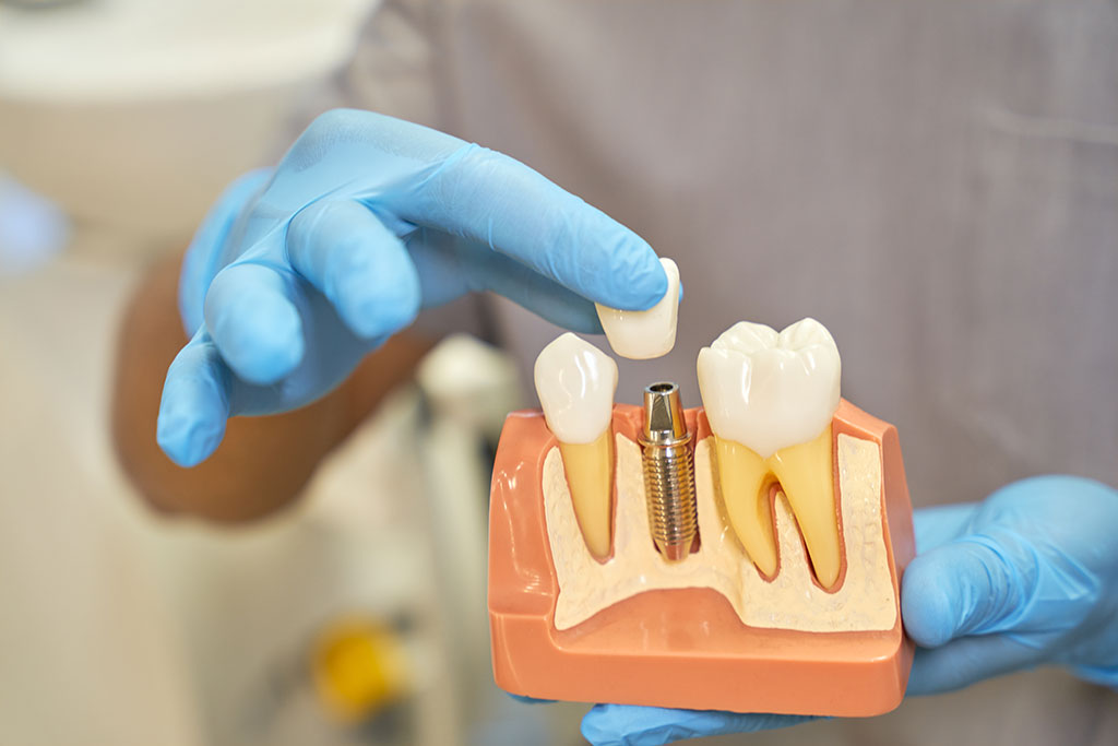 Implante dental: BiancaDent, Dentistas implantólogos en Castellón