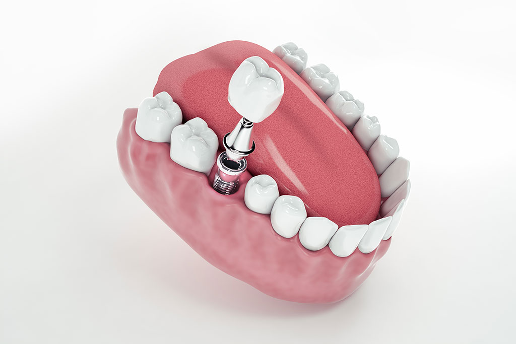 Implante Dental: BiancaDent, Dentistas en Castellón