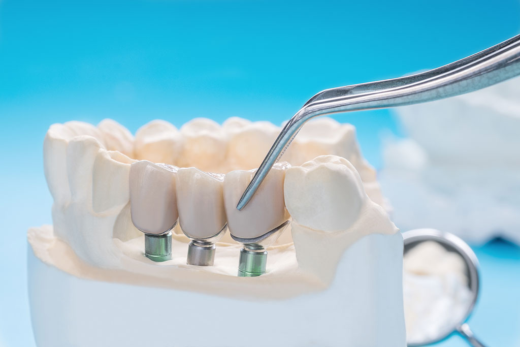 Puente dental con implantes: BiancaDent, Odontólogos en Castellón
