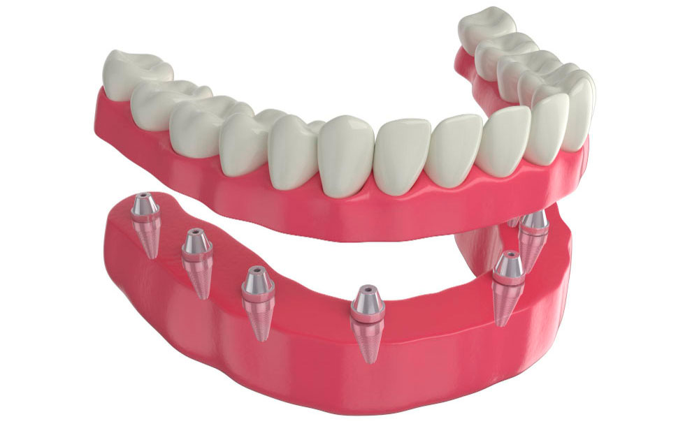 ¿Qué es una prótesis dental?: BiancaDent, Dentistas en Castellón