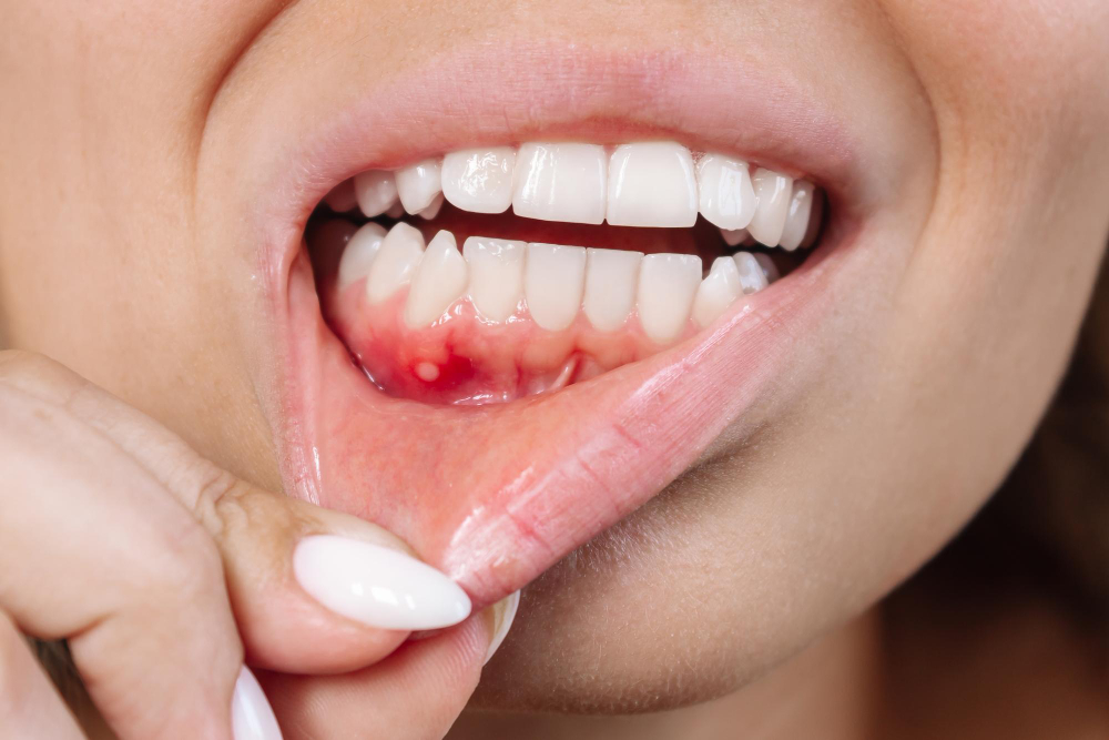 Llagas en la boca: BiancaDent, Clínica Dental en Castellón