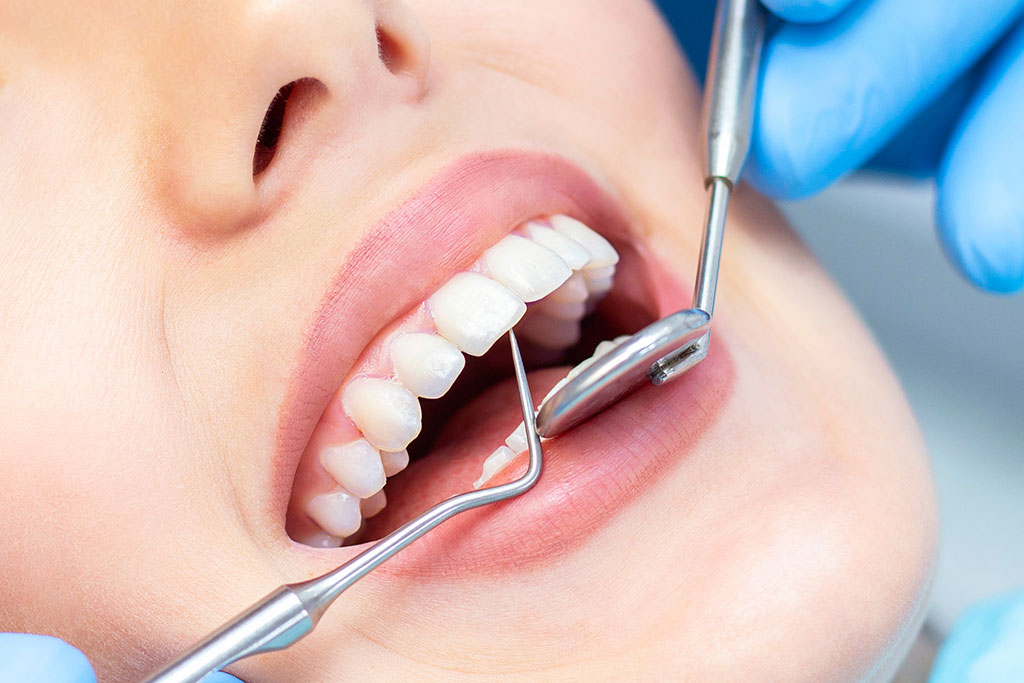 Diferencia entre periodontitis y gingivitis: BiancaDent, Periodoncia en Castellón