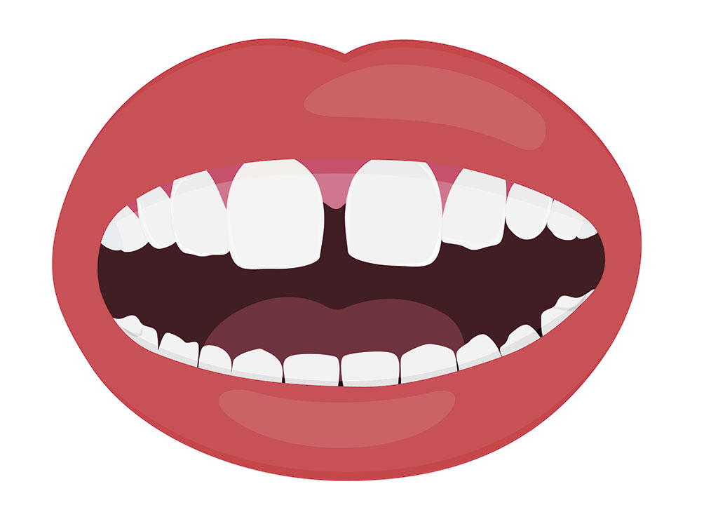 Causas y riesgos del Diastema dental: BiancaDent, Dentistas Castellón