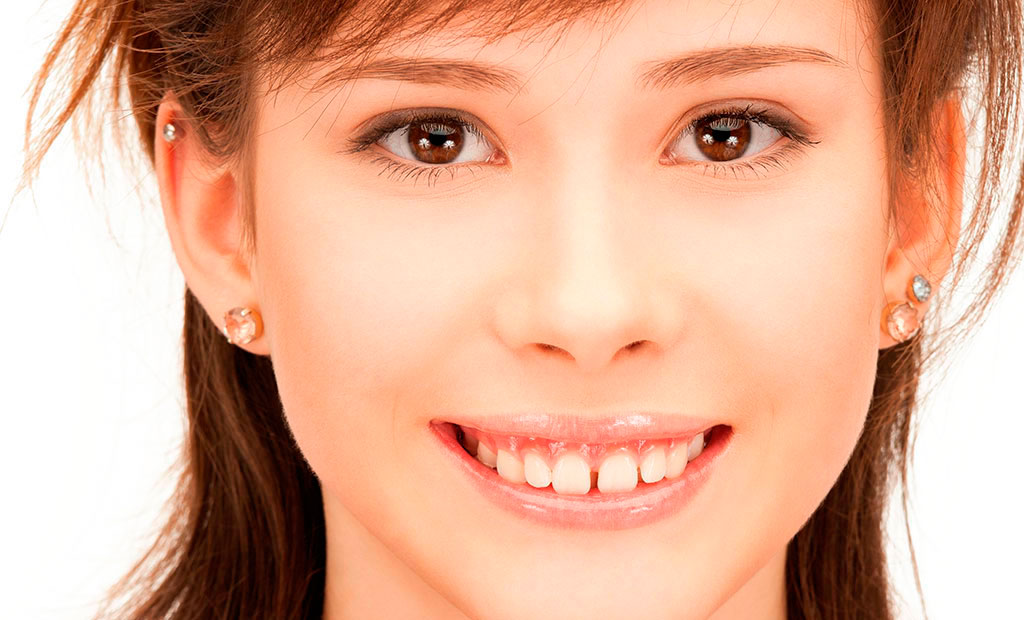 Diastema dental: BiancaDent, Clínica Dental en Castellón