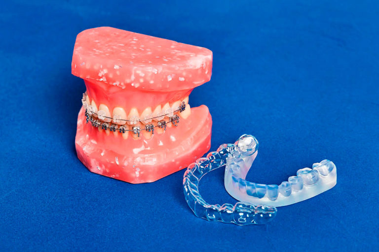 Maloclusión dental: BiancaDent, Clínica Dental en Castellón