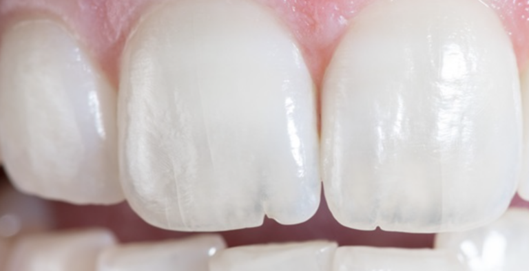 pequeñas líneas verticales visibles en el esmalte de los dientes anteriores